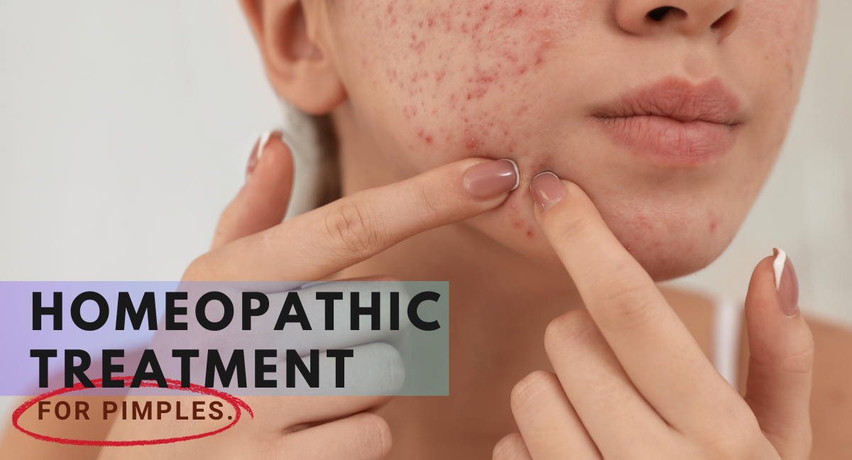 Homeopathic Treatment For Acne