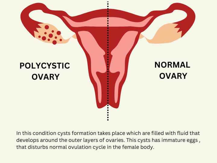 PCOS Homeopathy Treatment