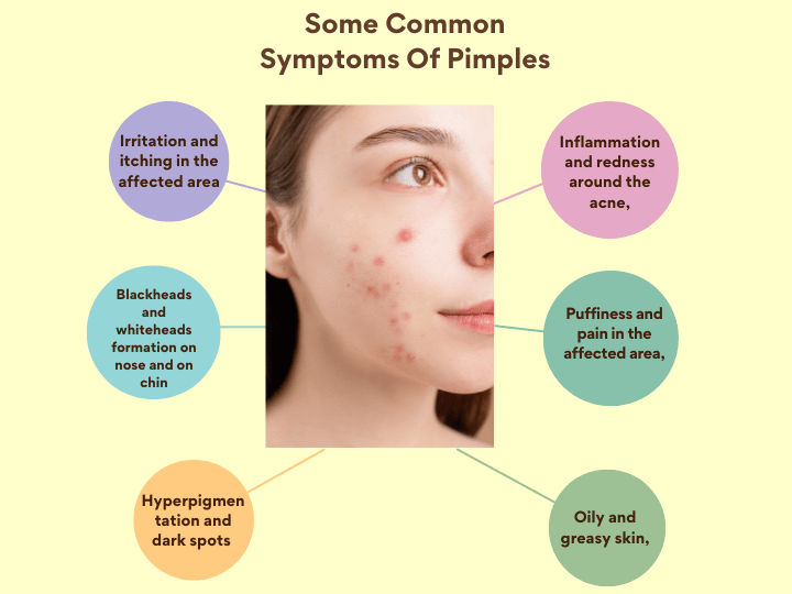 homeopathic treatment for acne