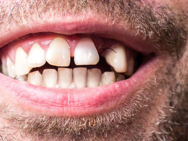 gaps between teeth