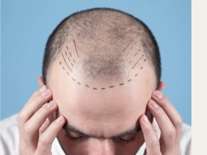 does hair transplant cause cancer